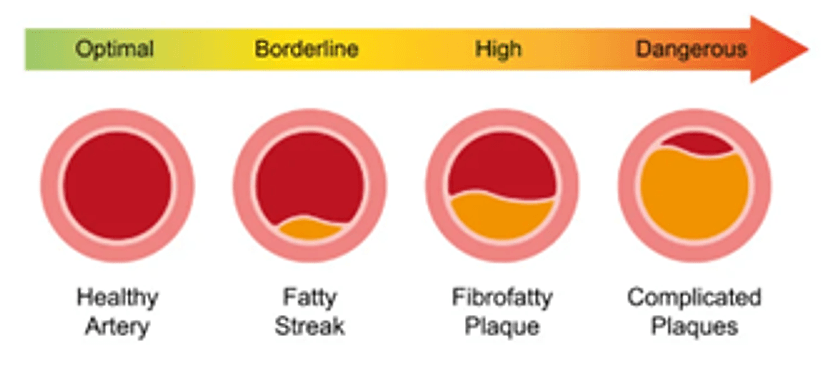 Diagram showing arterial plaque progression from healthy artery to complicated plaques